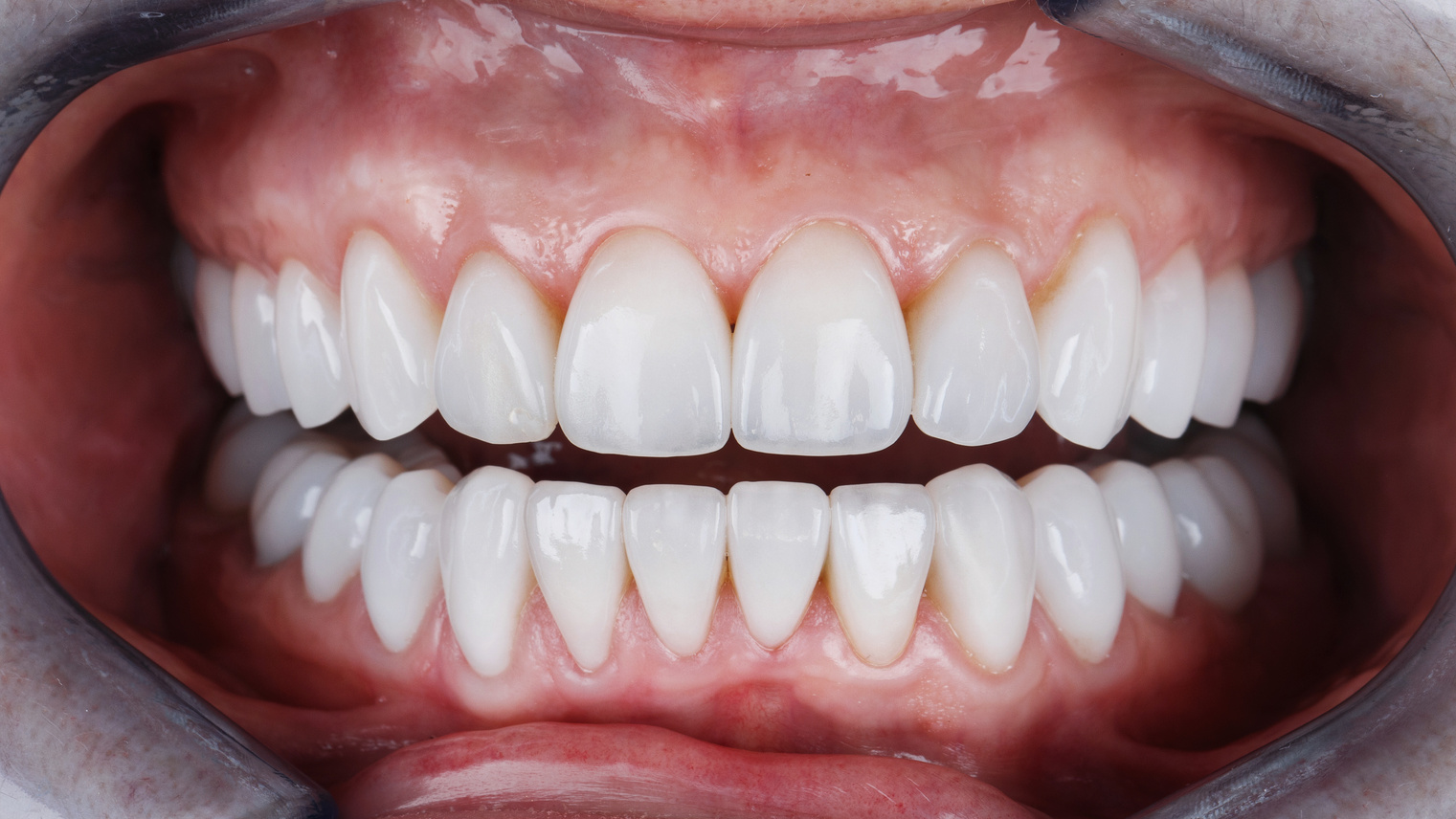 beautiful teeth with ceramic veneers of the patient's upper