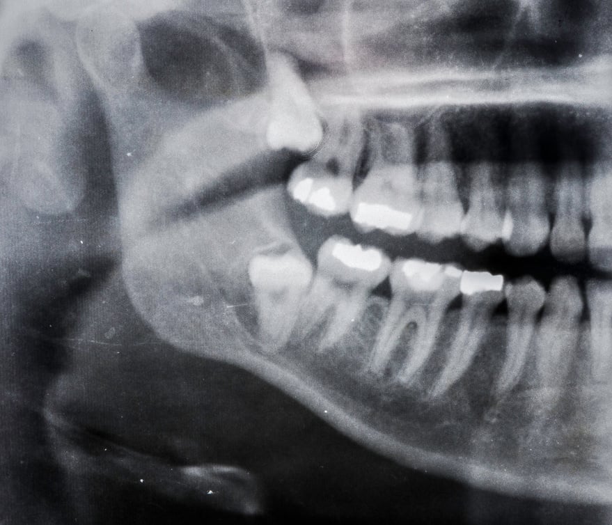 A wisdom tooth, in humans, is any of the usual four third molars. Wisdom teeth can develop, becoming impacted or "coming in sideways. Deeply impacted third morlar teeth or windom teeth.